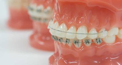 dr. Hermann Boglárka fogszabályozás